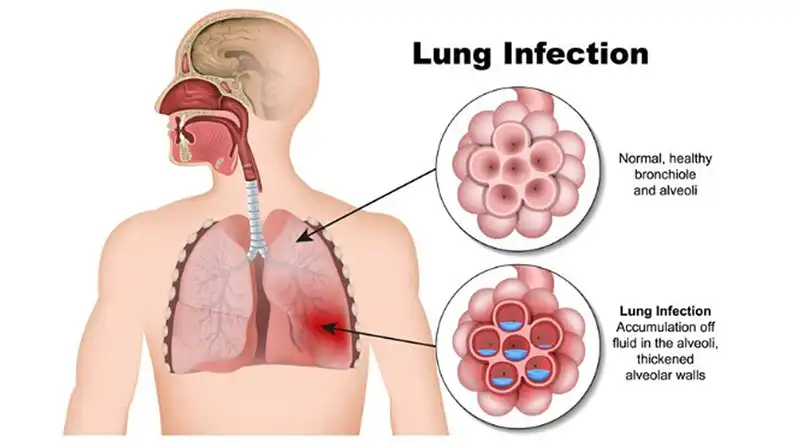 How Does Ivy Leaf Extract Powder Fit Modern Respiratory Care Product Formulas? How Does Ivy Leaf Extract Powder Fit Modern Respiratory Care Product Formulas?